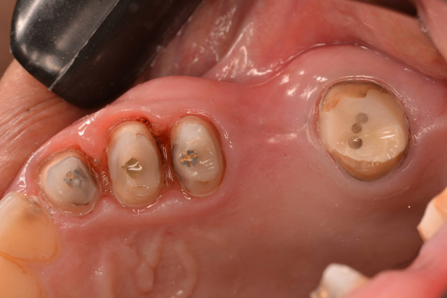 قبل تركيبات اسنان